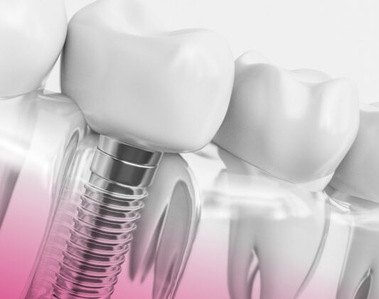 dentalni-implanti