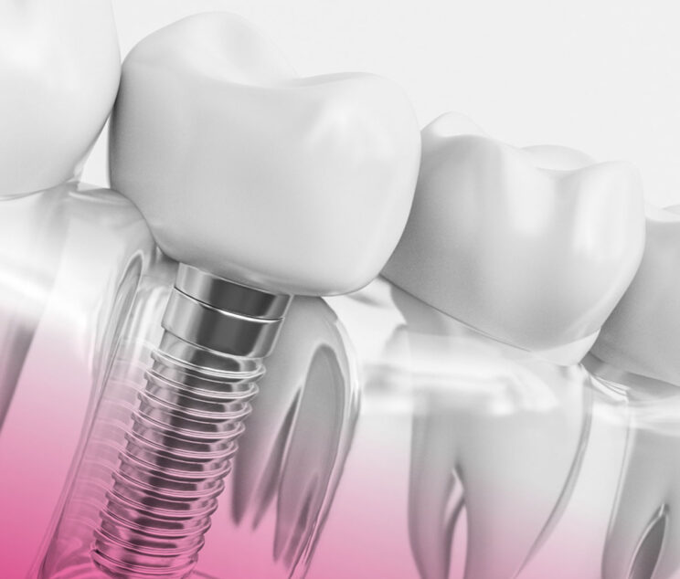 dentalni-implanti